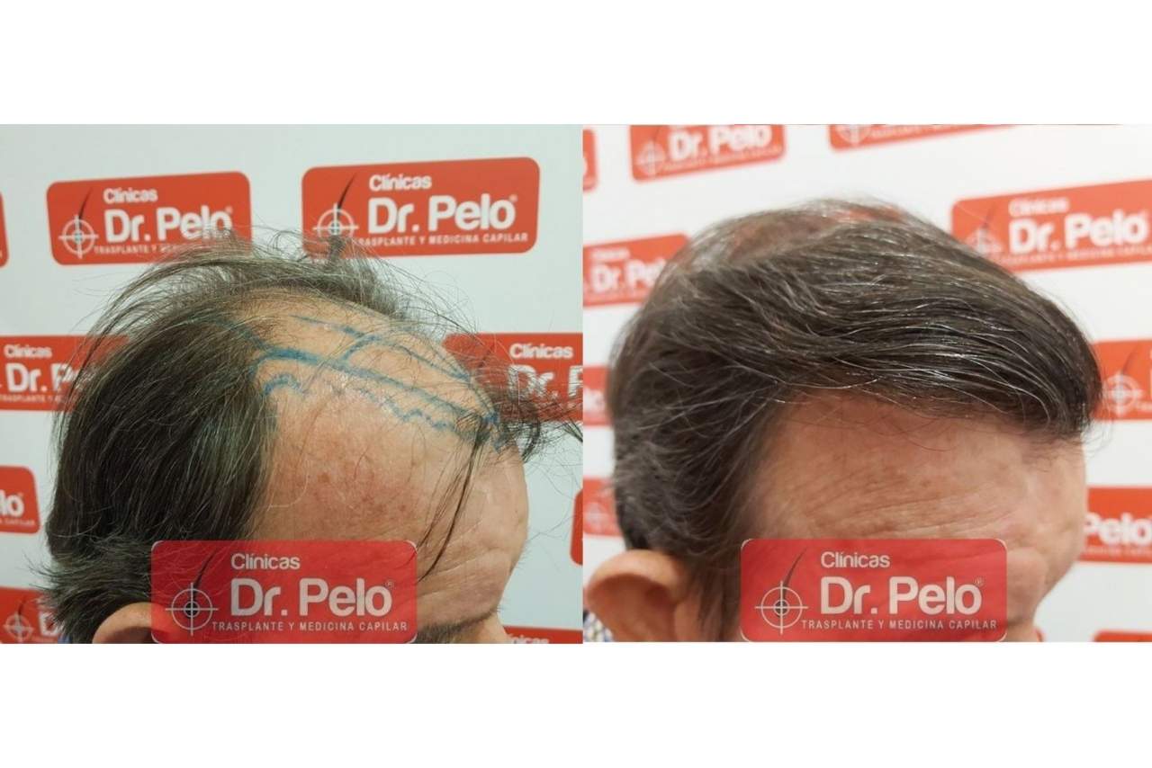 Trasplante capilar en Madrid con Clínicas Dr. Pelo