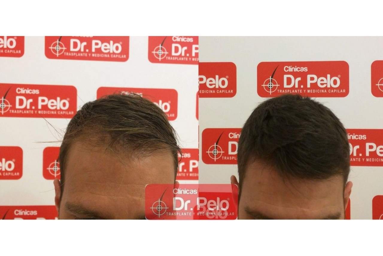 Clínicas Dr. Pelo: Señales de alopecia