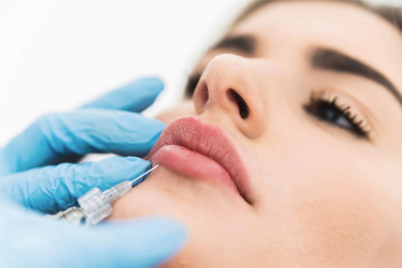 Diseño de labios con ácido hialurónico en Barcelona con Dr. Zito