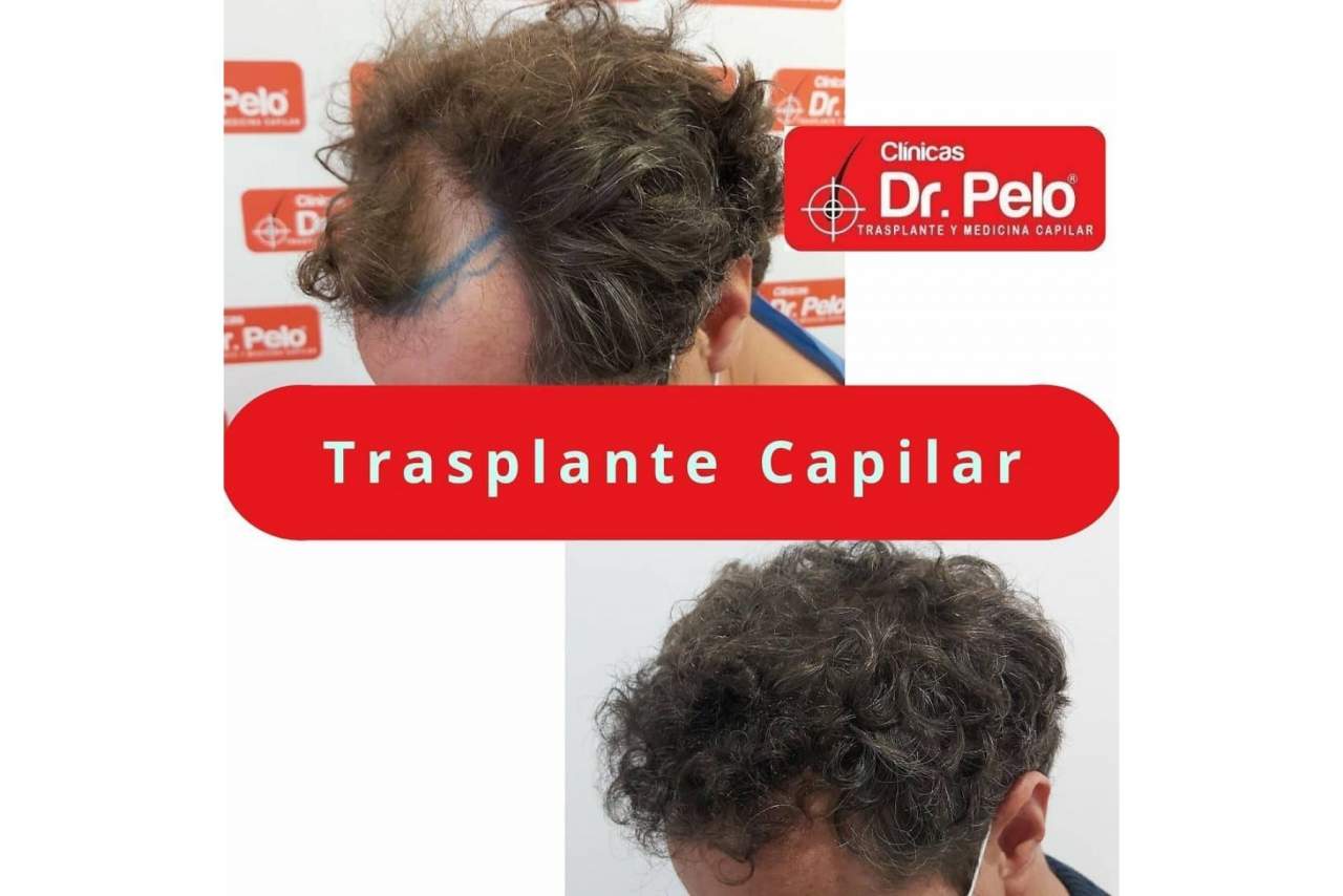 El transplante capilar gana popularidad en los últimos años en España tras mejorar los precios y las técnicas aplicadas
