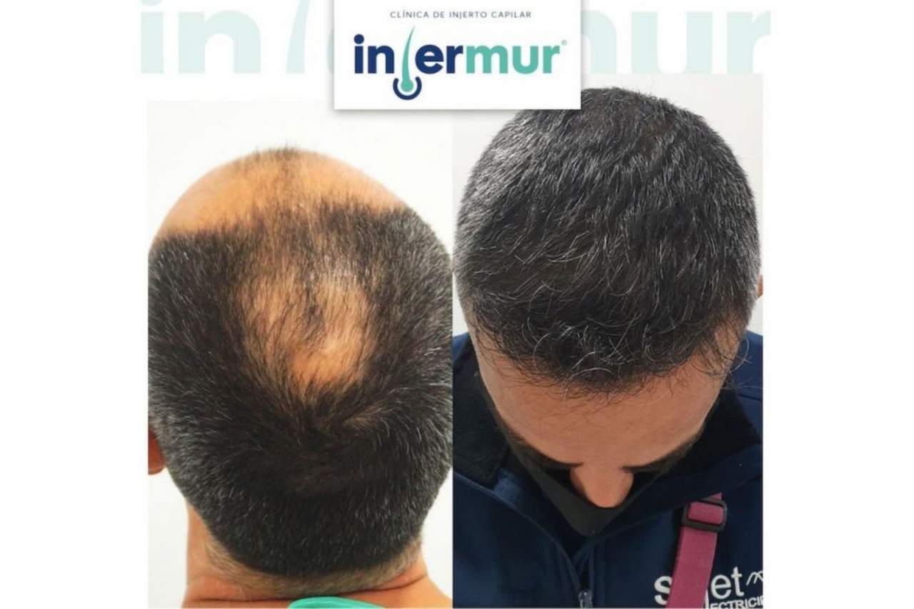 El pulso de España contra Turquía: precio asequible y apuesta por la innovación en la industria del injerto capilar