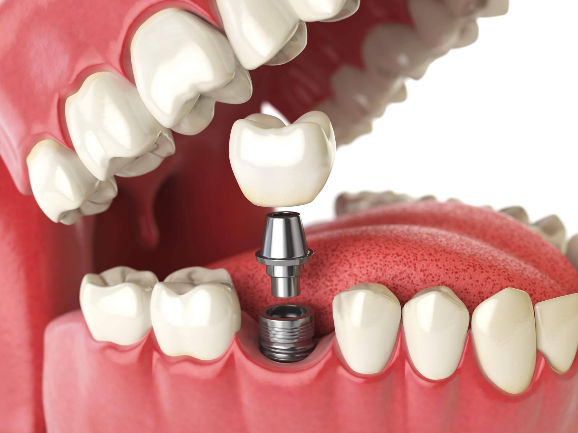 El exclusivo implante dental de titanio en la Clínica de Odontología Artydents de Madrid por solo 199€