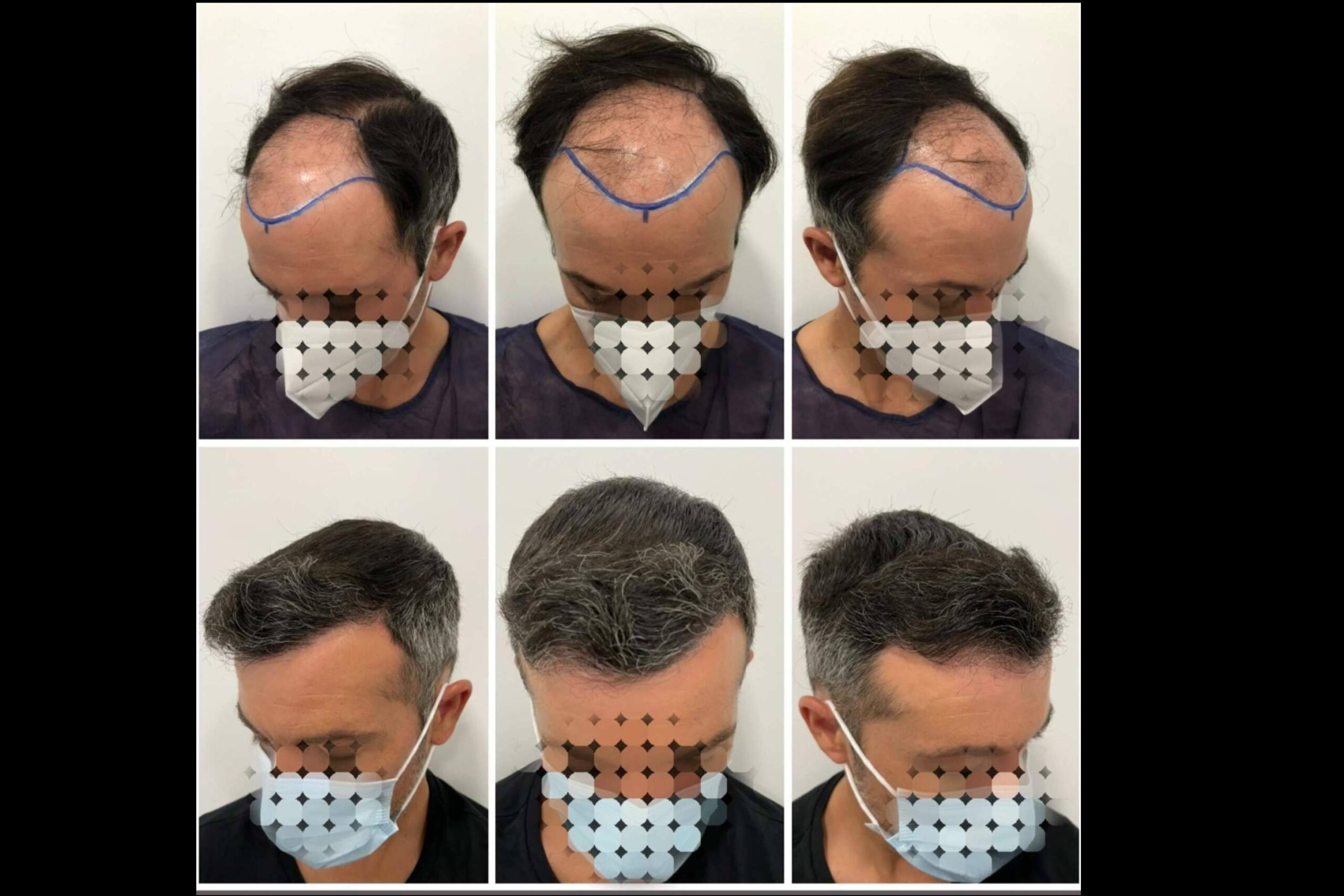 Las técnicas más recomendadas por el especializado Dr Bruno Jacobovski son el injerto o trasplante capilar