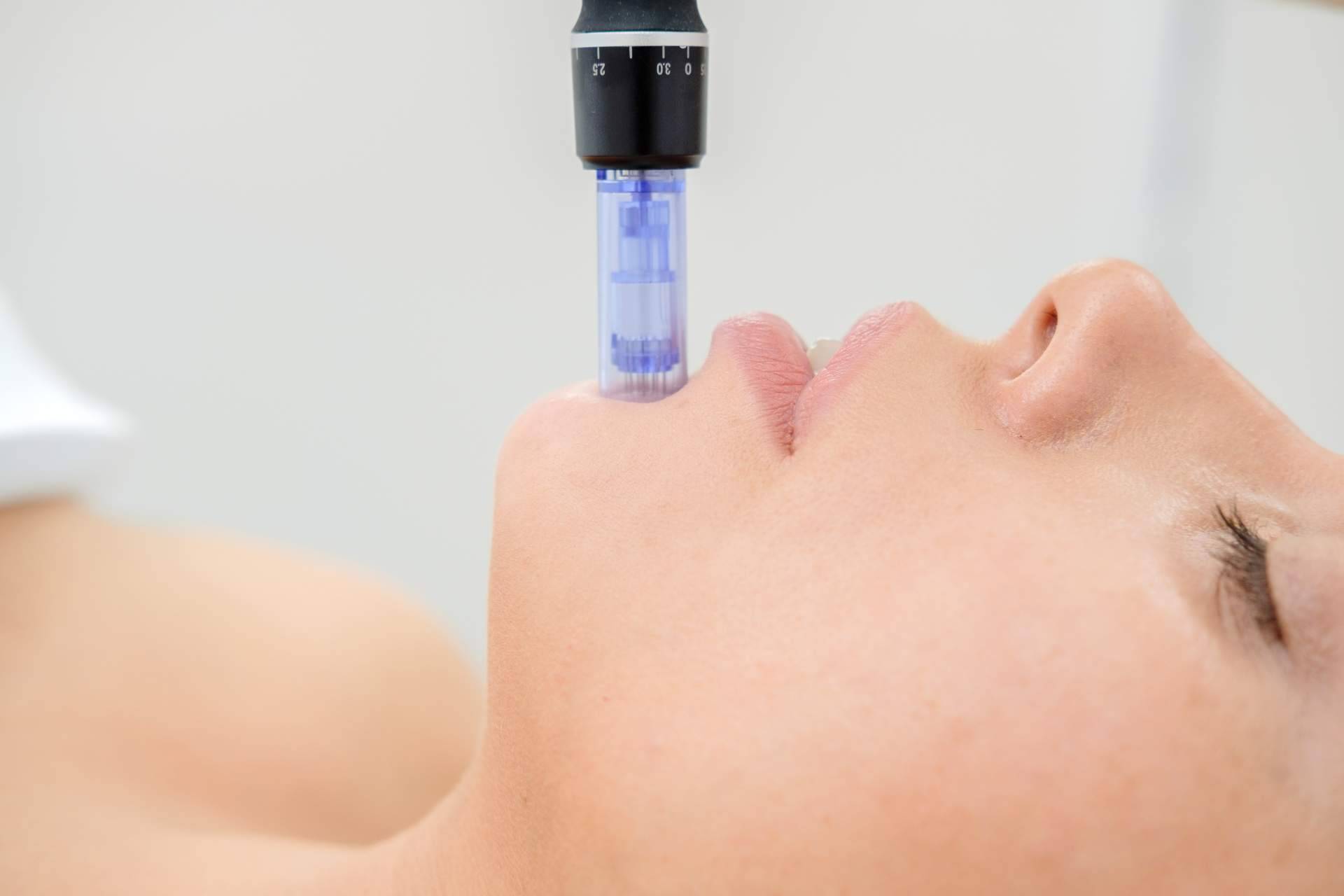 El procedimiento de la mesoterapia facial de VG Virginia Gómez