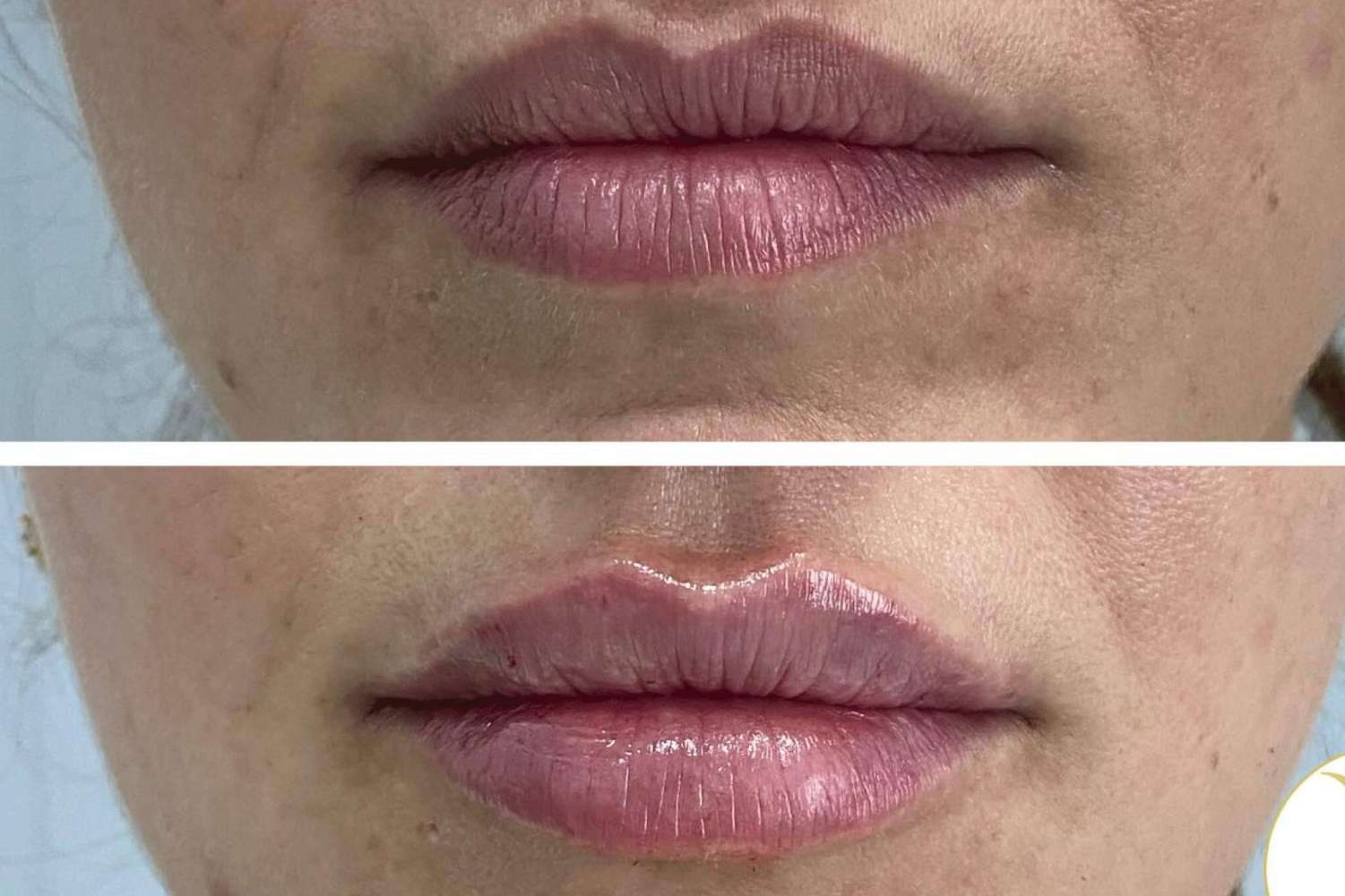 La técnica, Adiblips, de la Clínica Yasmin para el aumento de labios con ácido hialurónico