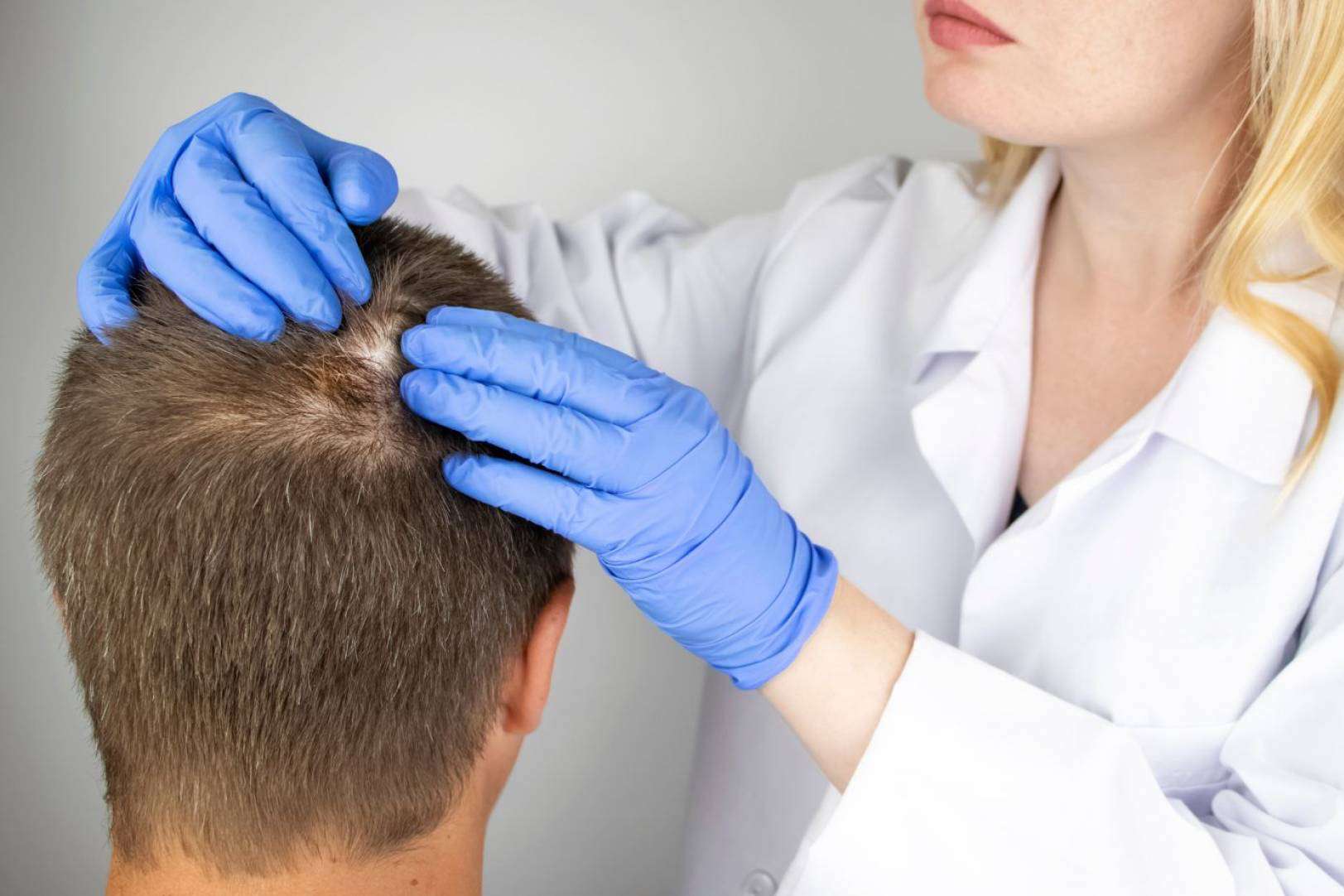 La Clínica Capilar Laura Agrelo explica los diferentes tipos de alopecia