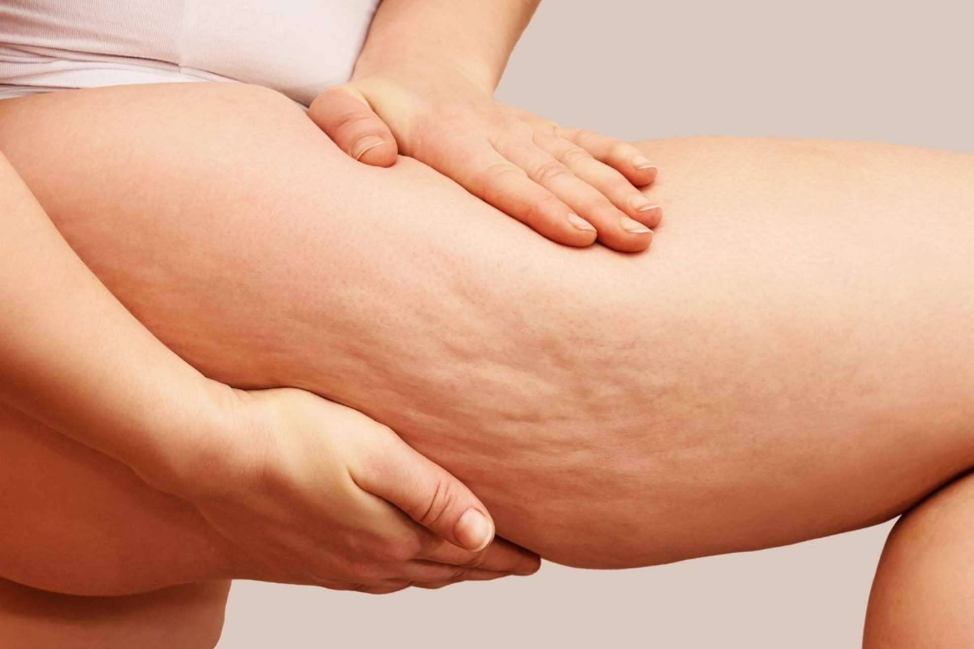 ¿Qué es la celulitis? Causas y soluciones