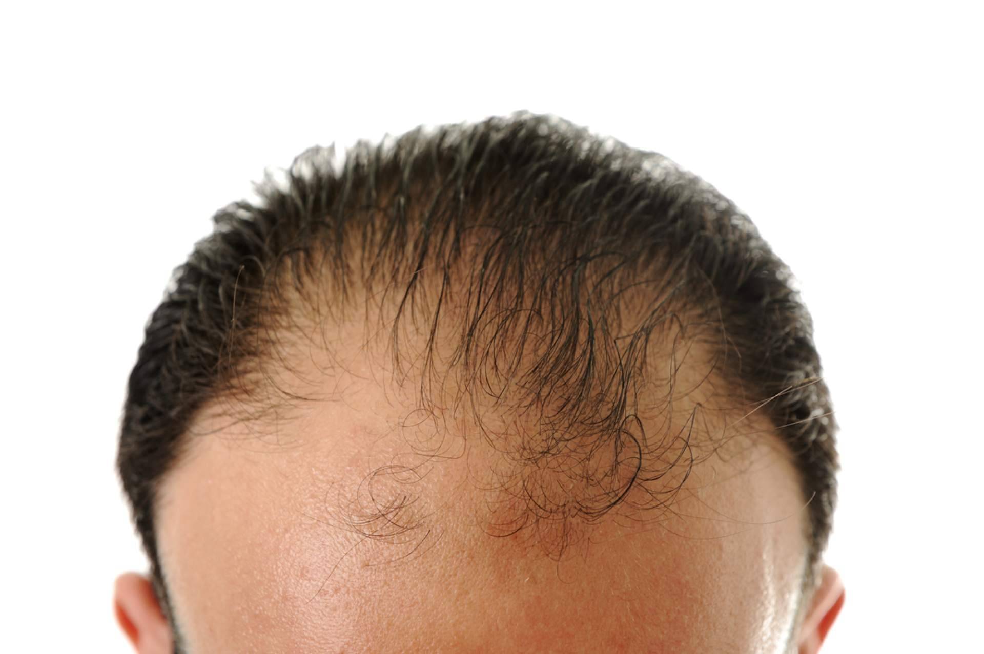 HairFluencer presenta una selección de sus mejores productos para el cuidado post trasplante capilar