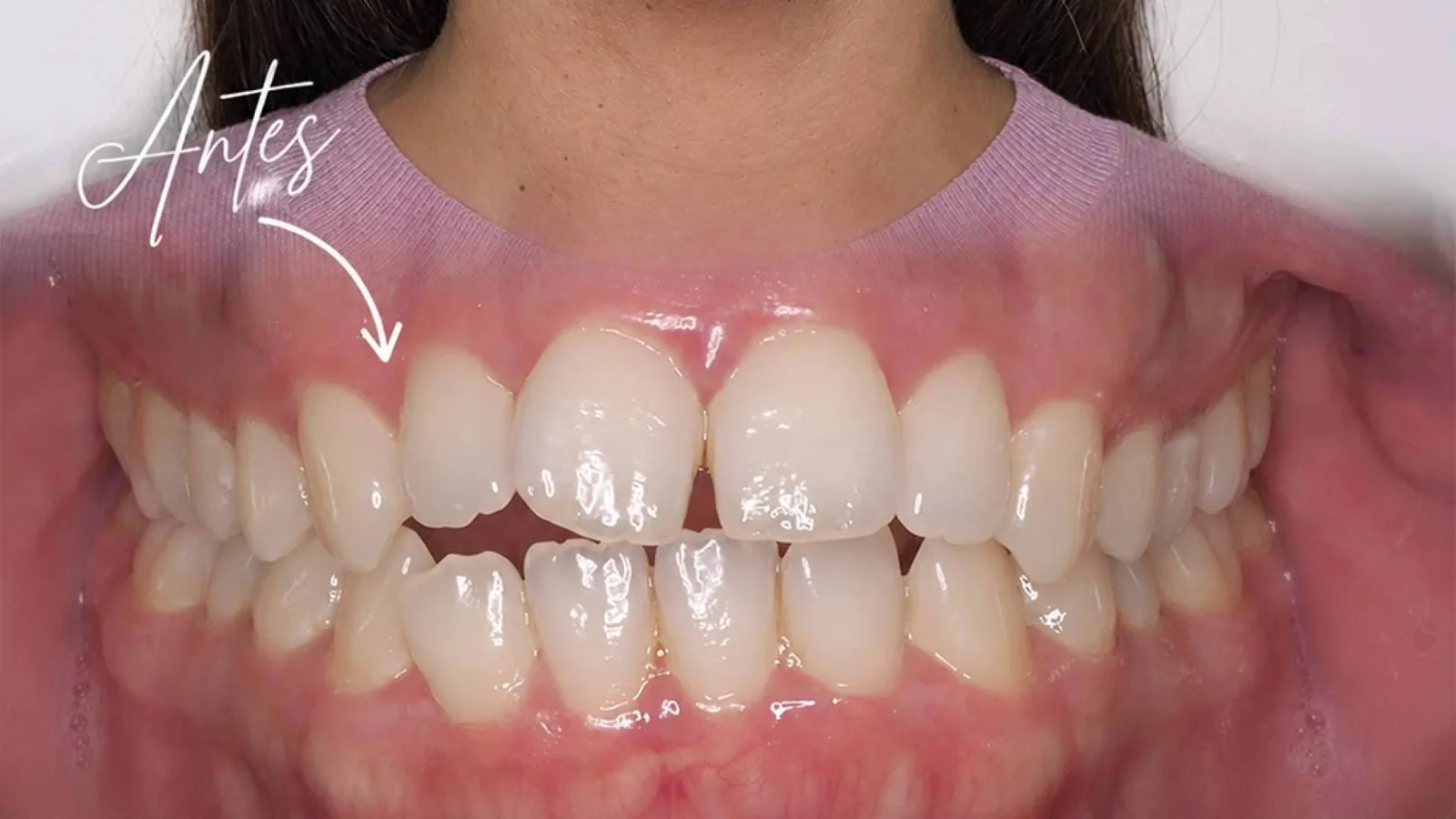 Clínica Calvo de Mora aborda casos complejos mediante cirugía maxilofacial e implantología avanzada